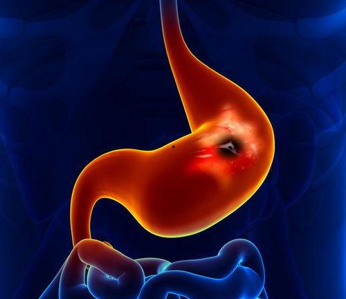 胃癌术后吃蒋瓜好吗